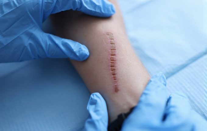 scar treatment image